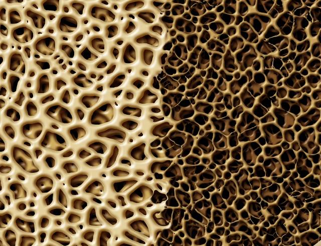 Osteoporose